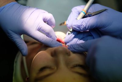 Tooth Removal | Just A Smile Away Dental